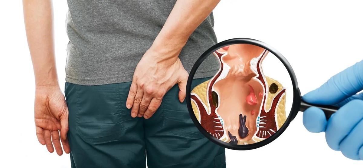 Hemoroid Hastaları İçin Yaşam Rehberi